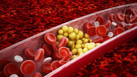 Cholesterin: Animation von Fettzellen, die den Blutfluss blockieren. 