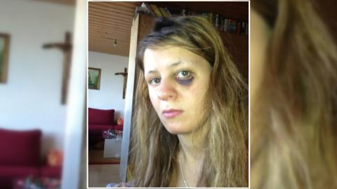 Toxische Beziehungen: Selfie einer jungen Frau mit einem blauen Auge.